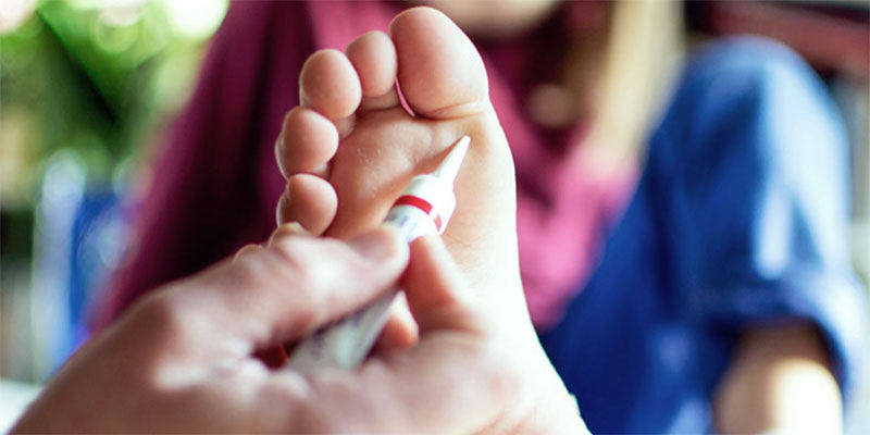 Help! Warts! What You Need to Know About Causes and Removal