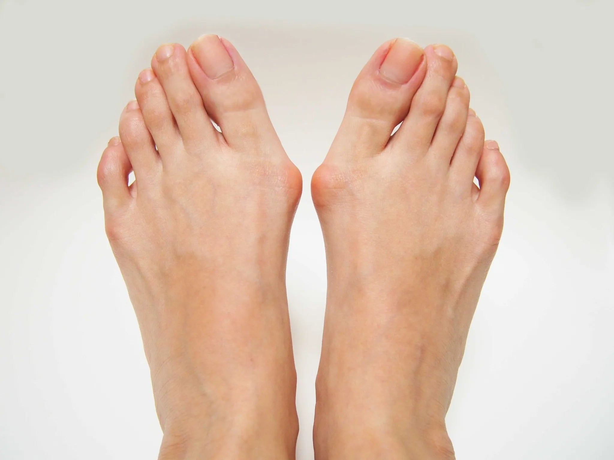 Bunions: What They Are and How to Treat Them