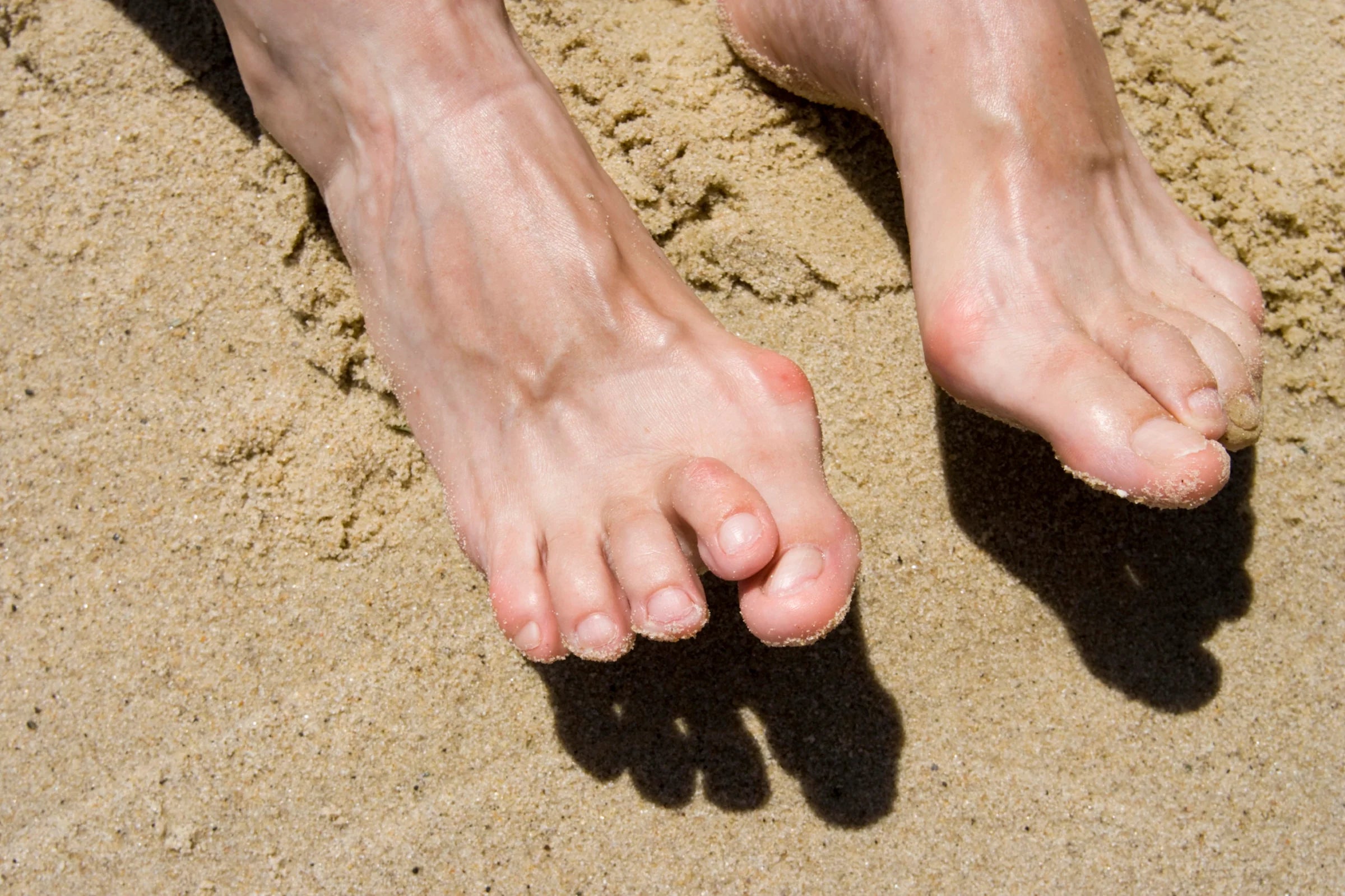Understanding Hammer Toe: Causes, Treatment & Prevention
