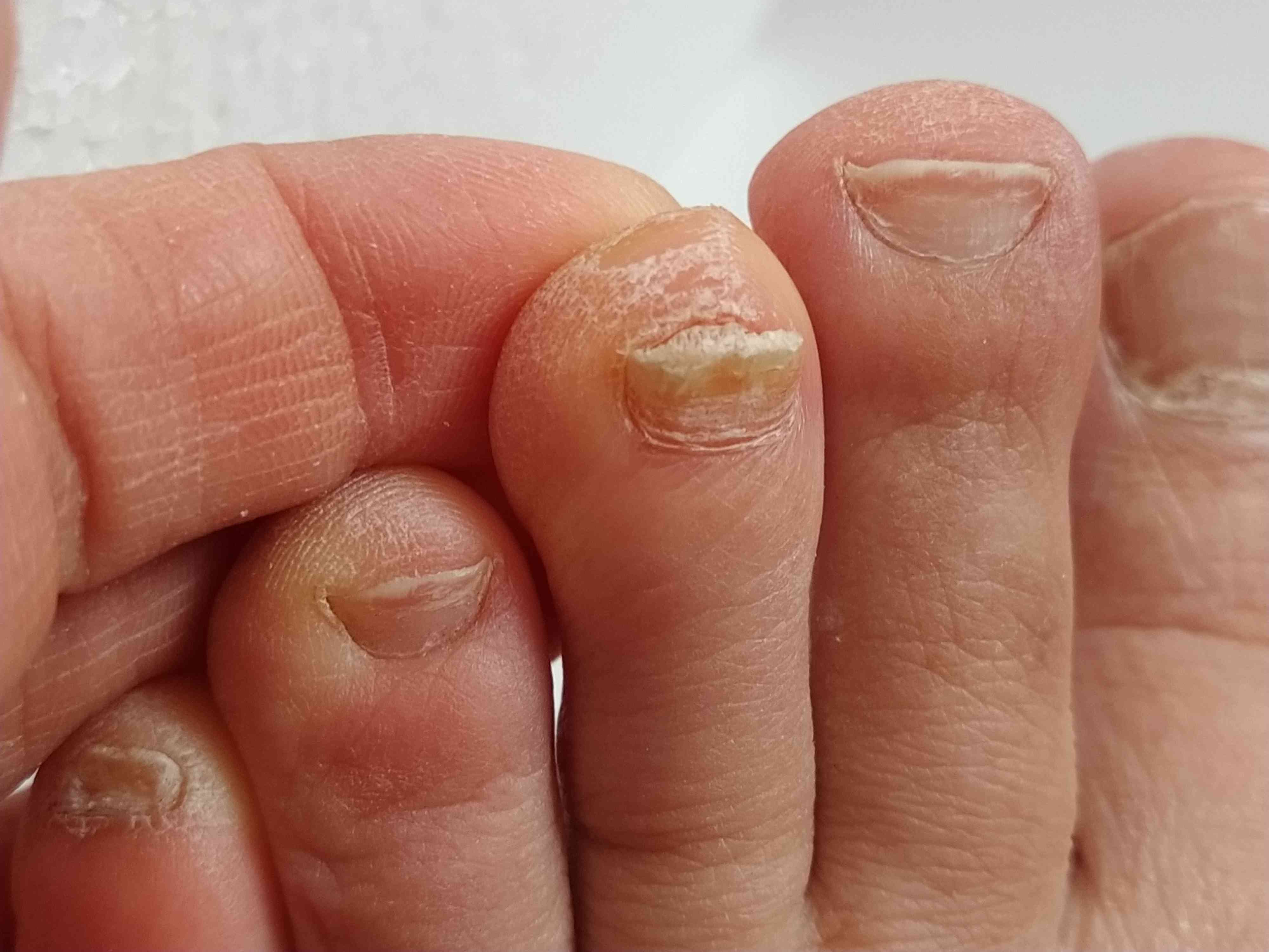 Everything You Need to Know About Damaged Toenails