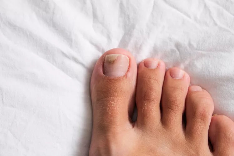 Fungal and Nail Infections: What You Need to Know