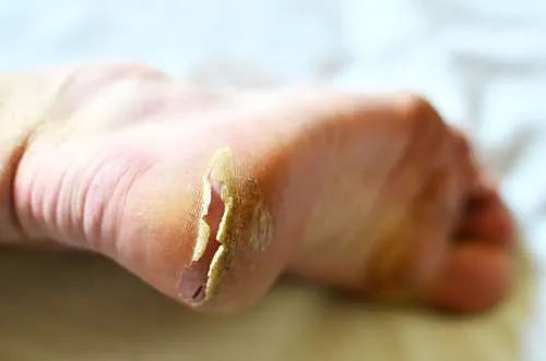 Why Urea is Essential for Cracked Heel Treatment