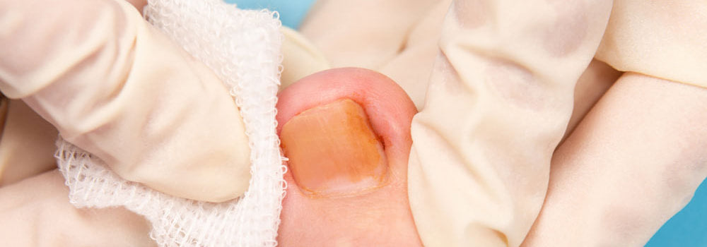 Ingrown Toenails: Causes, Prevention and Treatment
