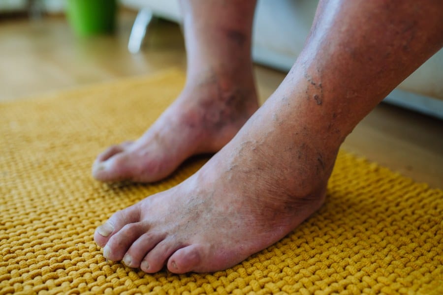 Diabetic Foot Care: Essential Tips for Healthy Feet