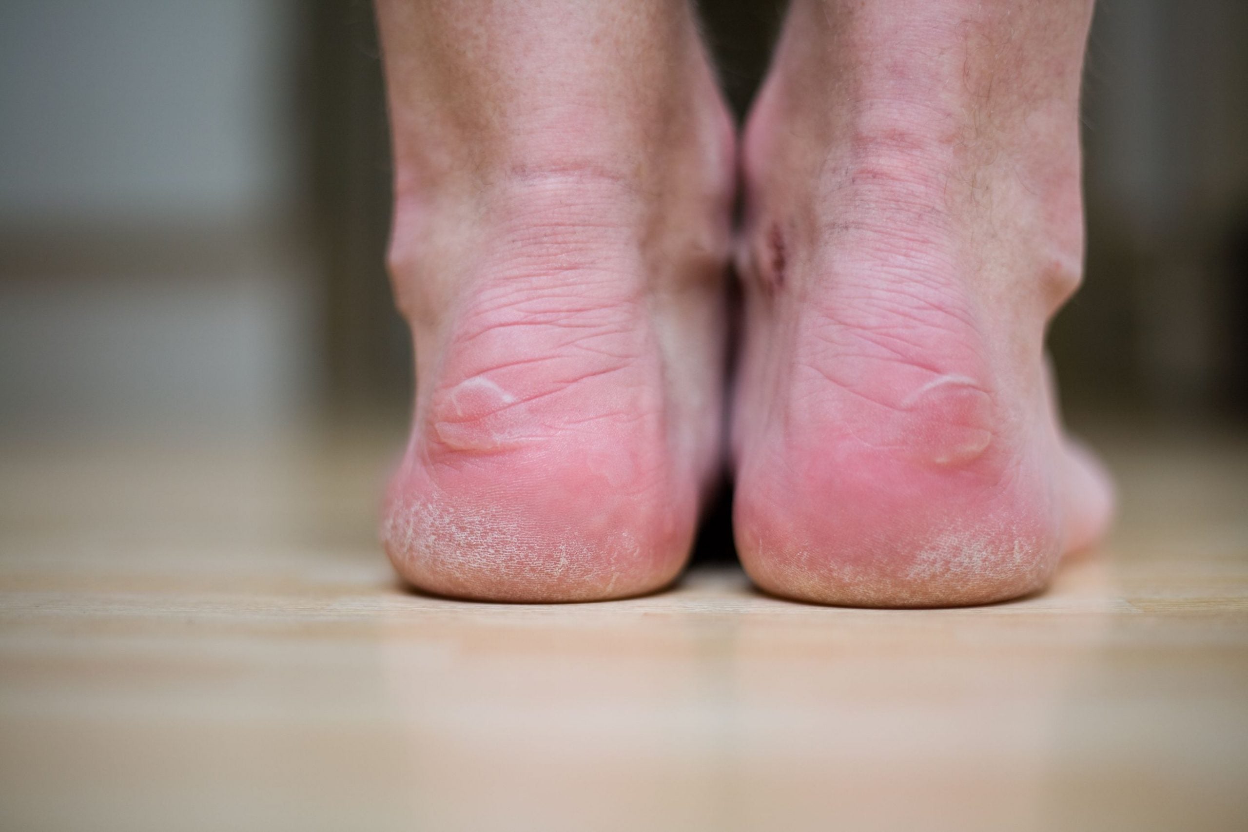 Blisters: Causes, Prevention and Treatment for Healthy Feet