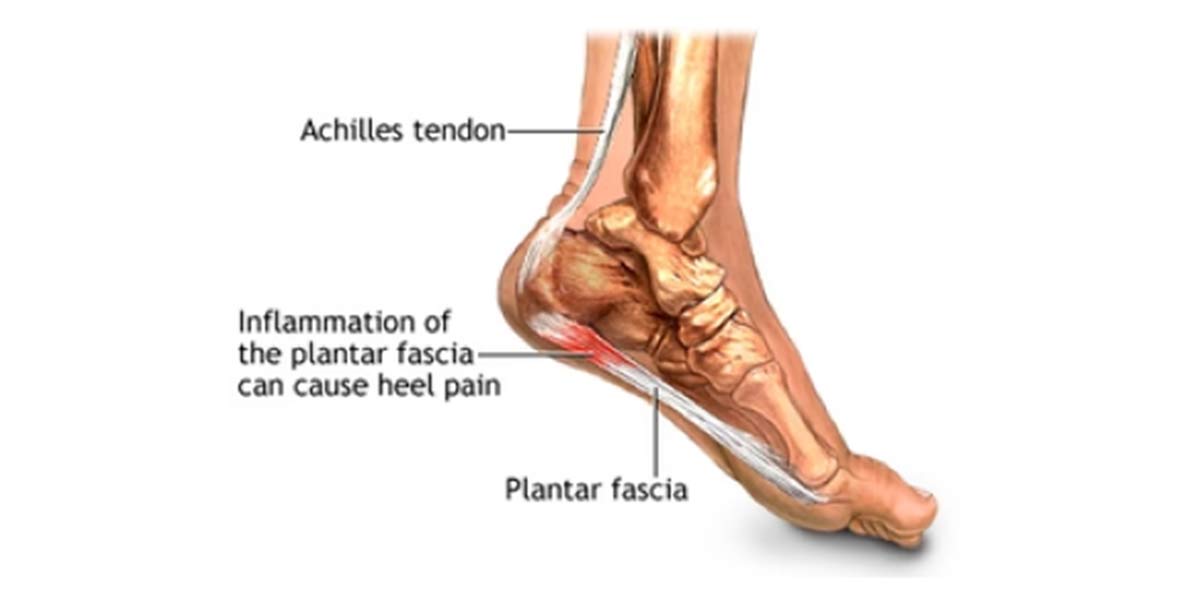 Plantar Fasciitis: Causes, Symptoms & How to Find Relief