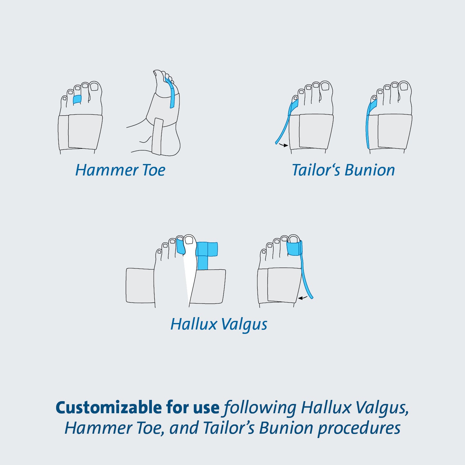 Darco TAS-Toe Alignment Splint